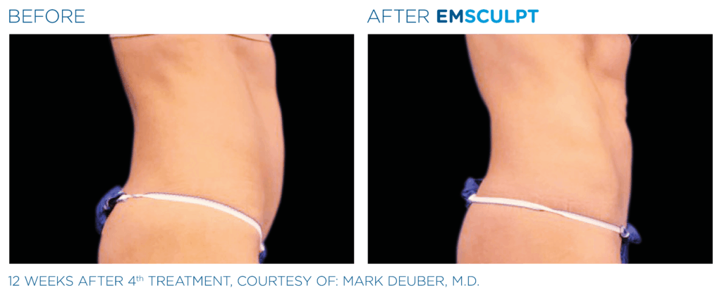 emsculpt before and after