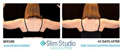 SLIM STUDIO - results of Atlanta coolsculpting inner & outer thighs before & after photo