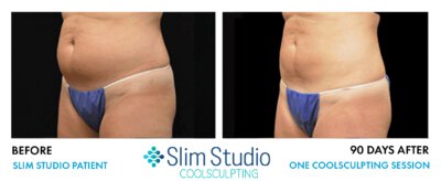 SLIM STUDIO - Atlanta coolsculpting abdomen before & after photo
