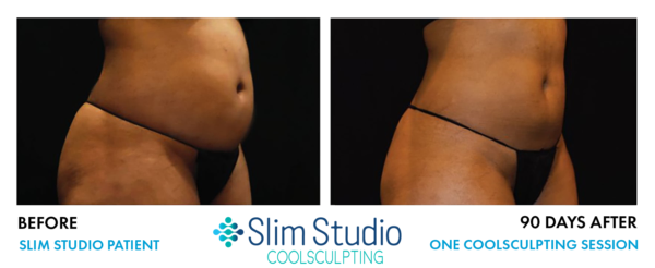 CoolSculpting before and after
