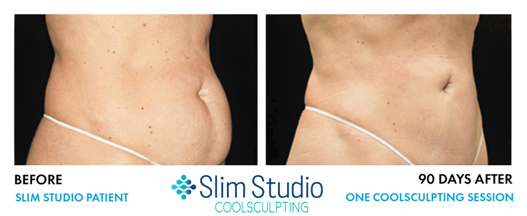 SLIM-STUDIO-coolsculpting-abdomen-before-&-after--results-4