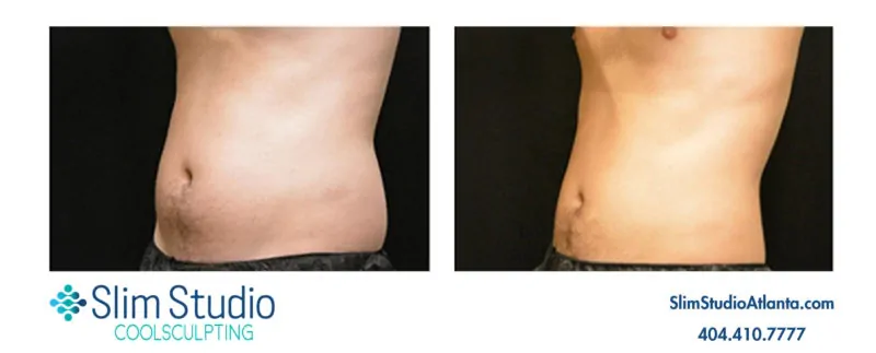 EMSculpt NEO at Slim Studio Atlanta, build muscle Break up cellulite