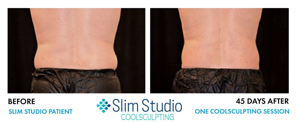 SLIM STUDIO - results of coolsculpting male flanks love handles before & after pic 14