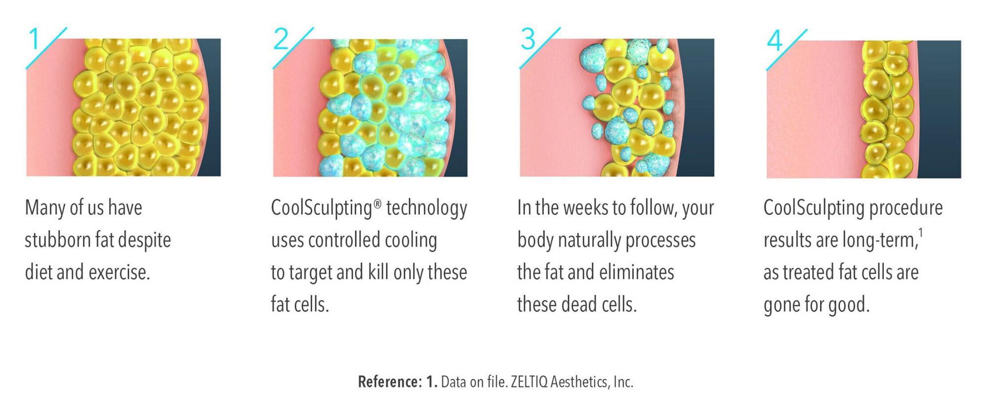 CoolSculpting process infographic