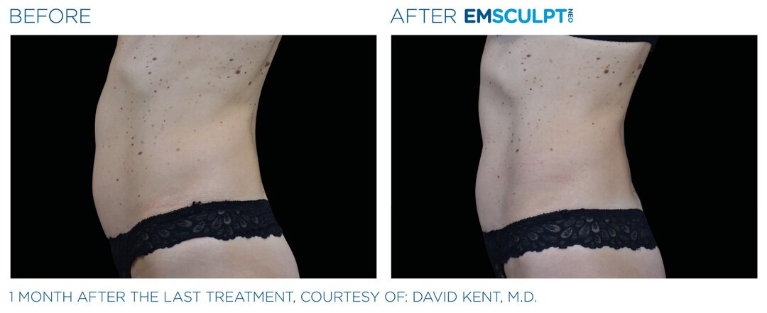 Before and After EMSCULPT on female