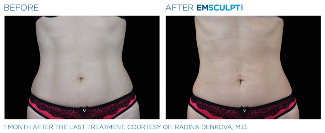 Before and After Atlanta EMSCULPT of actual slim studio client