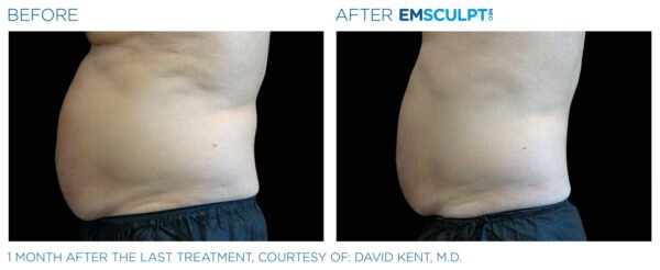 Before and After EMSCULPT on male abs in Atlanta
