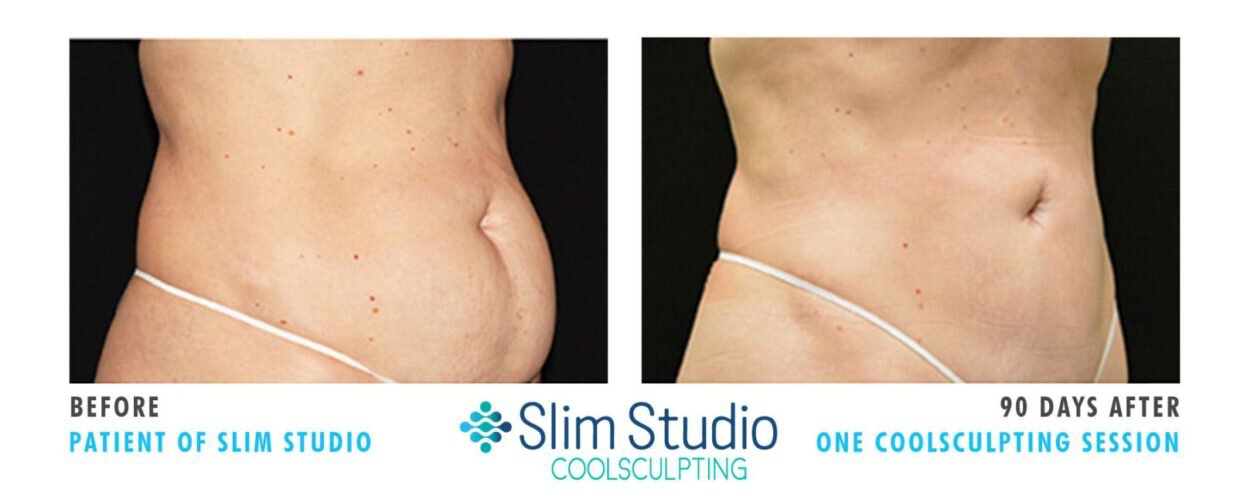 COOLSCULPTING before and After of actual Slim Studio patient