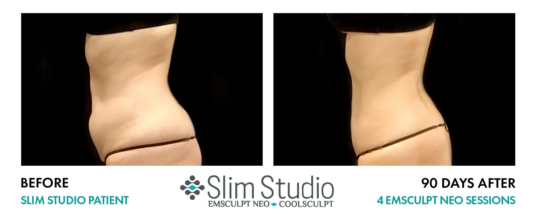 Awesome Results on Abs from Slim Studio CoolSculpting