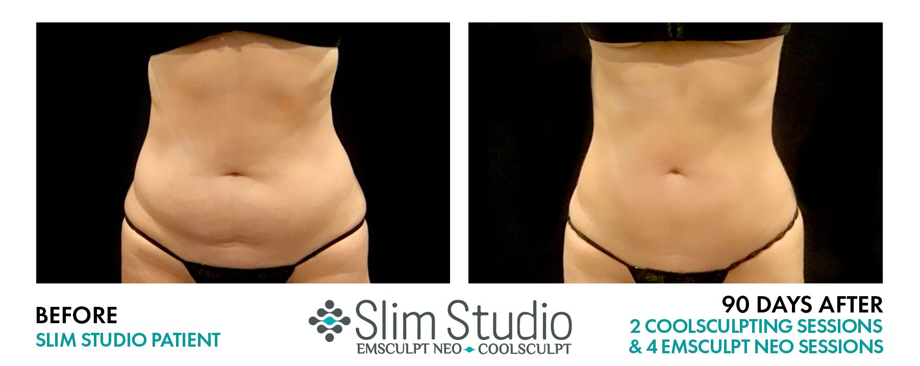 Awesome Results on Abs from Slim Studio CoolSculpting