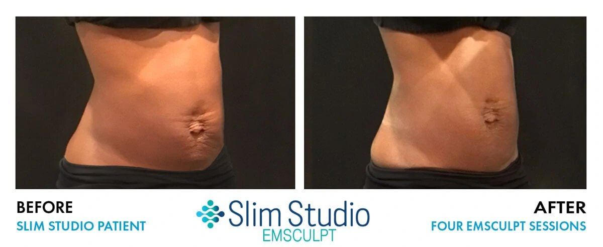 Before & After Gallery | Slim Studio Atlanta | Best EMSCULPT Treatment