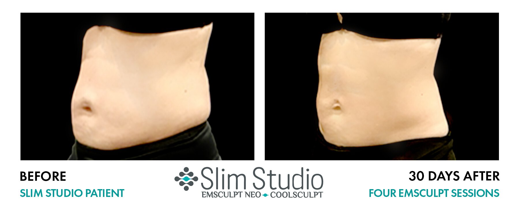 Awesome Results on Abs from Slim Studio EMSculpt