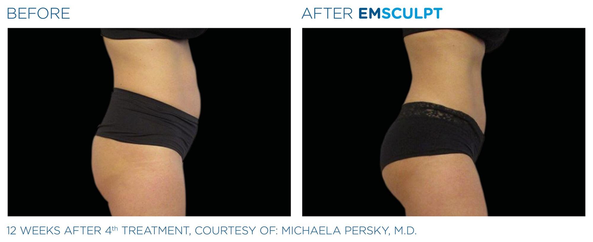 EmSculpt before and after