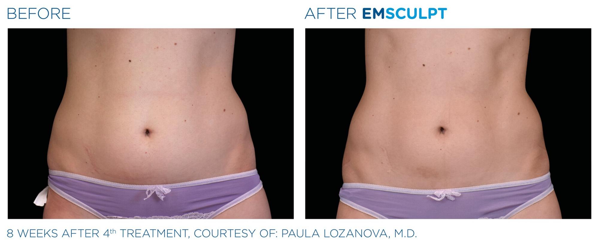 EmSculpt before and after