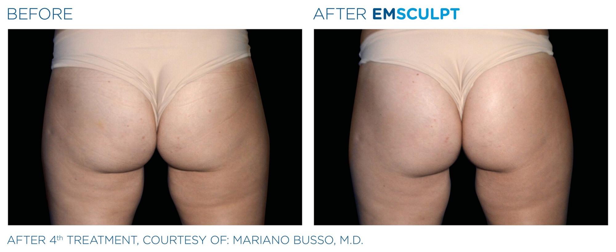 EMSculpt before and after