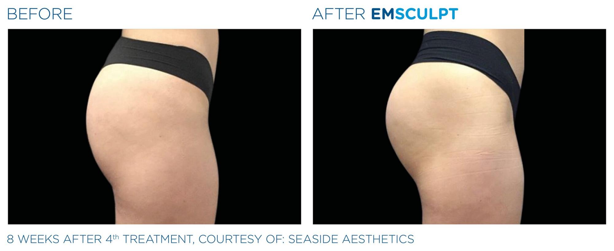 EMSculpt before and after
