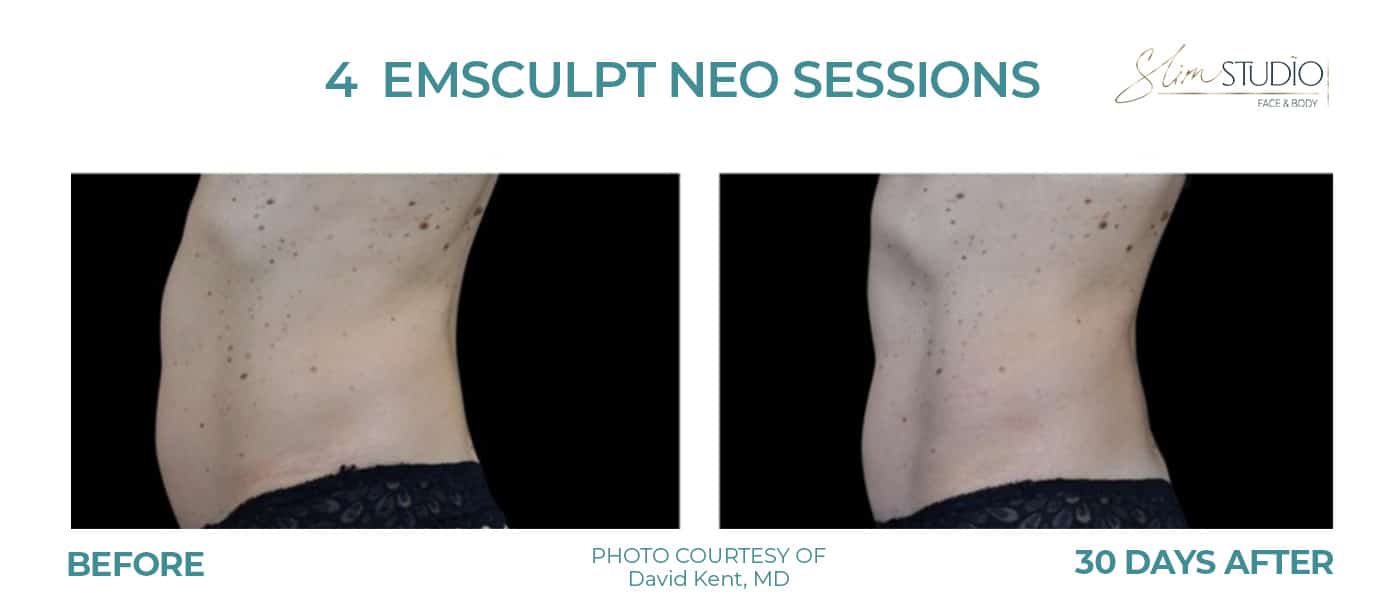 Before and After Image: EMSculpt NEO – Abs - left-side