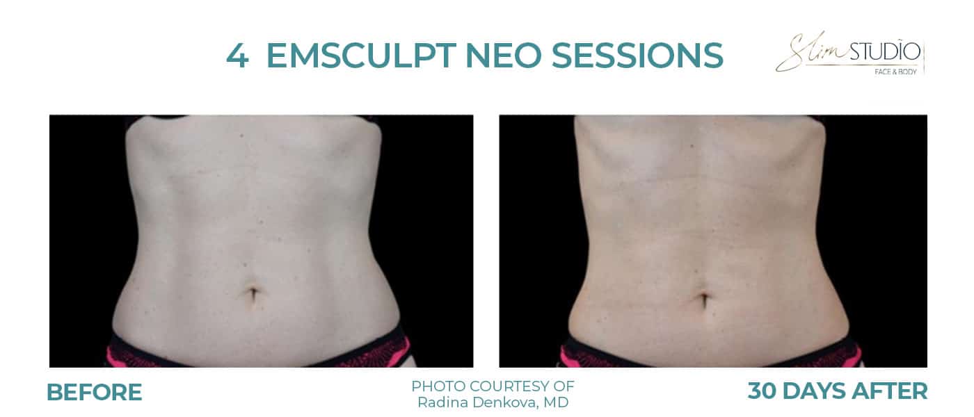 Before and After Image: EMSculpt NEO – Abs - front