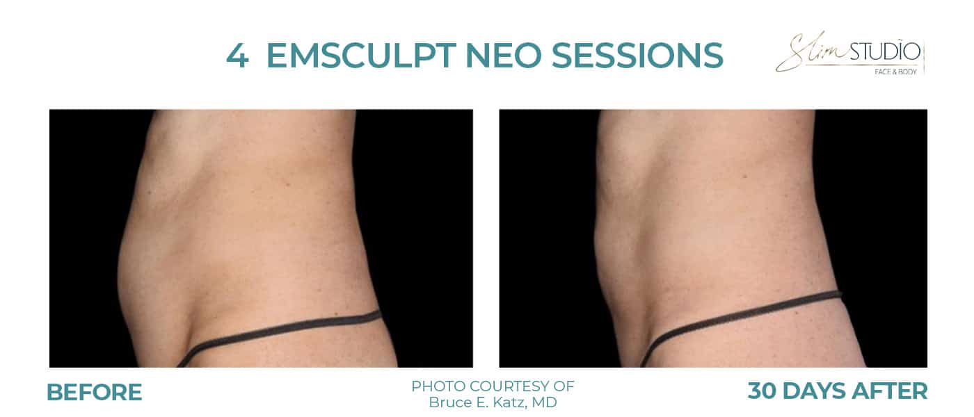 Before and After Image: EMSculpt NEO – Abs - left-side
