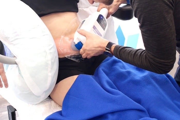 Does CoolSculpting Work?