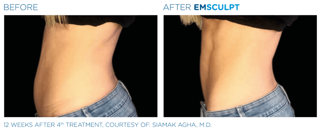 EMSculpt before and after