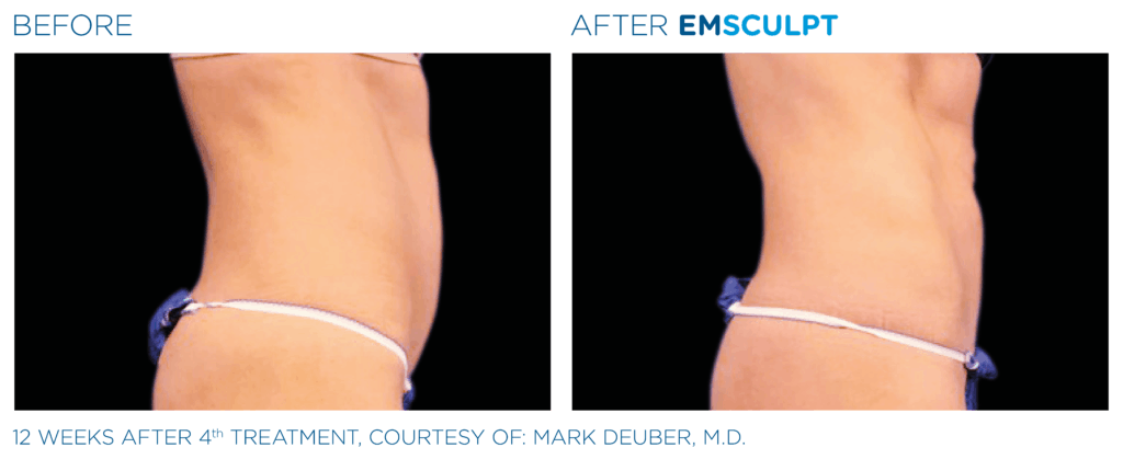 EMSculpt before and after