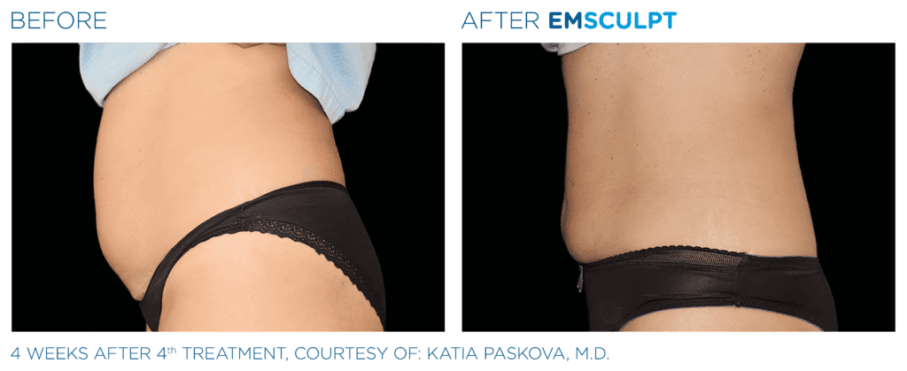 EMSculpt before and after