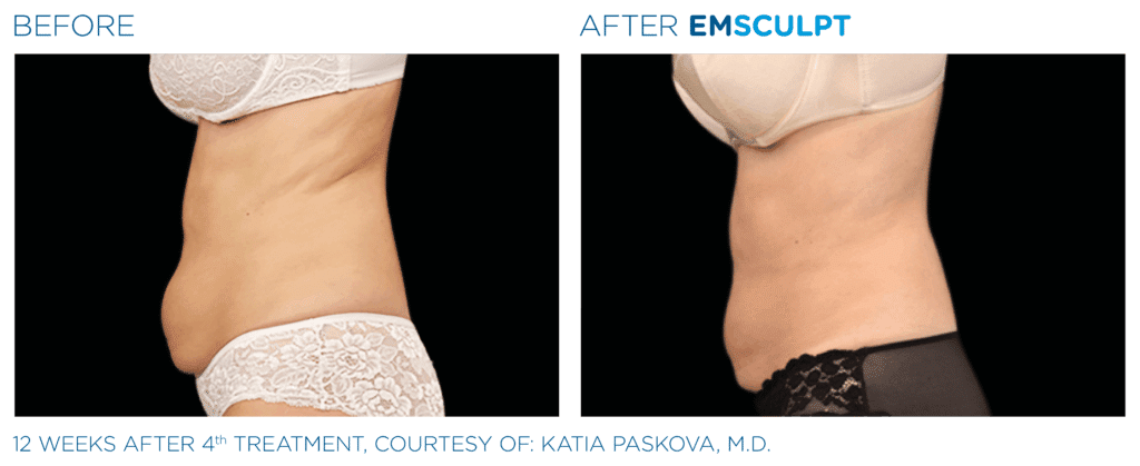 EMSculpt before and after