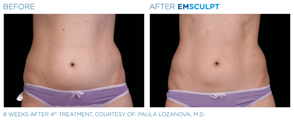 EMSculpt before and after