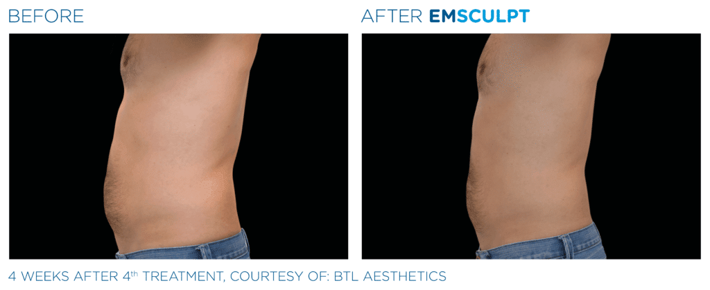 EMSculpt before and after