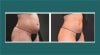 CoolSculpting patients before and after Video