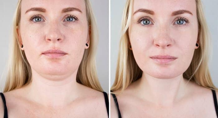 Atlanta CoolSculpting before and after
