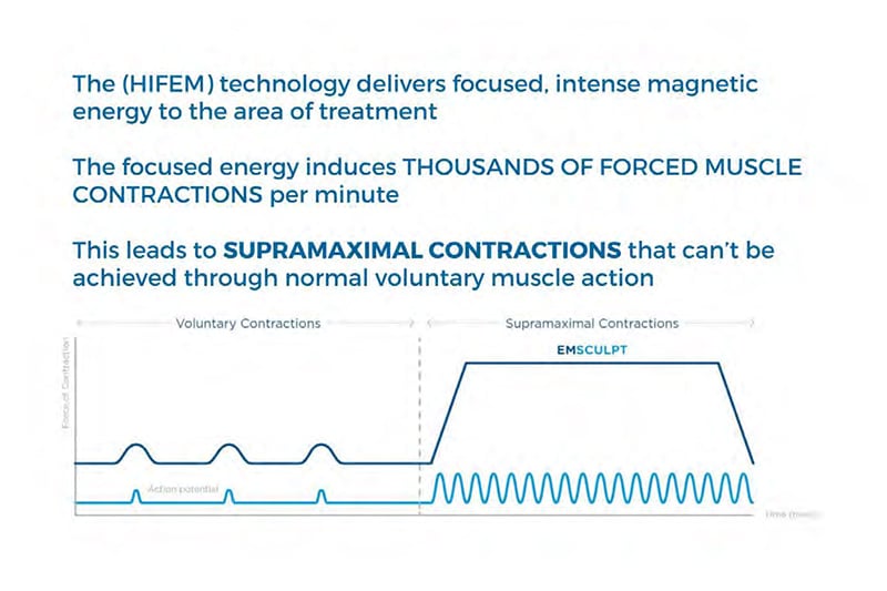 (HIFEM) technology
