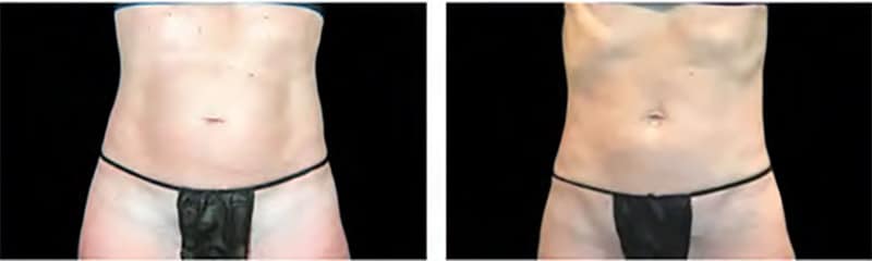 BEFORE & AFTER EMSculpt NEO