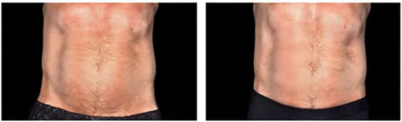 BEFORE & AFTER EMSculpt NEO