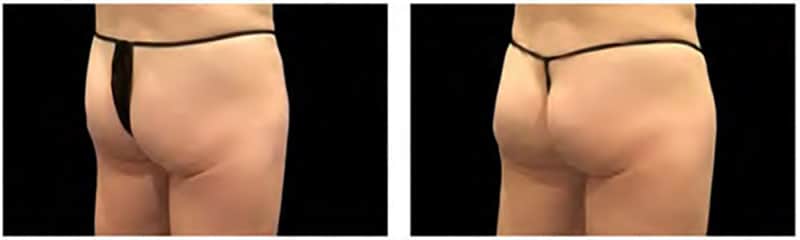BEFORE & AFTER EMSculpt NEO