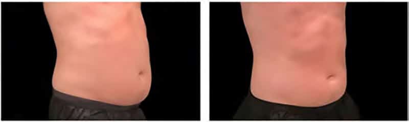 BEFORE & AFTER EMSculpt NEO