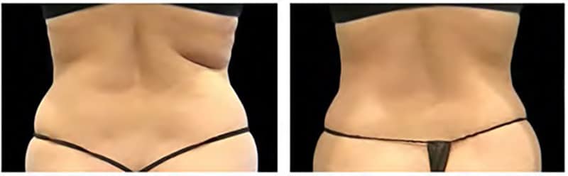 BEFORE & AFTER COOLSCULPTING