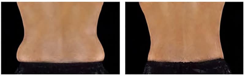 BEFORE & AFTER COOLSCULPTING