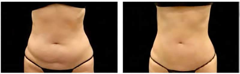 BEFORE & AFTER EMSculpt NEO & COOLSCULPTING