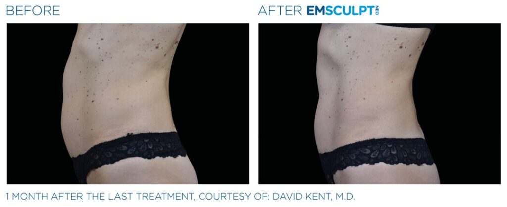 1775608160_emsculpt-neo-before-after-results-female-abdomen-abs-2 EMSculpt NEO Atlanta