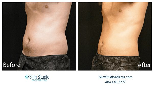 1775609070_men-02 Atlanta CoolSculpting For Men patient model
