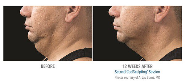 1775609078_men-03 Atlanta CoolSculpting For Men patient model