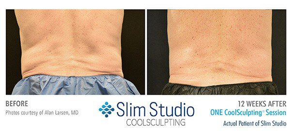 1775609088_men-04 Atlanta CoolSculpting For Men patient model
