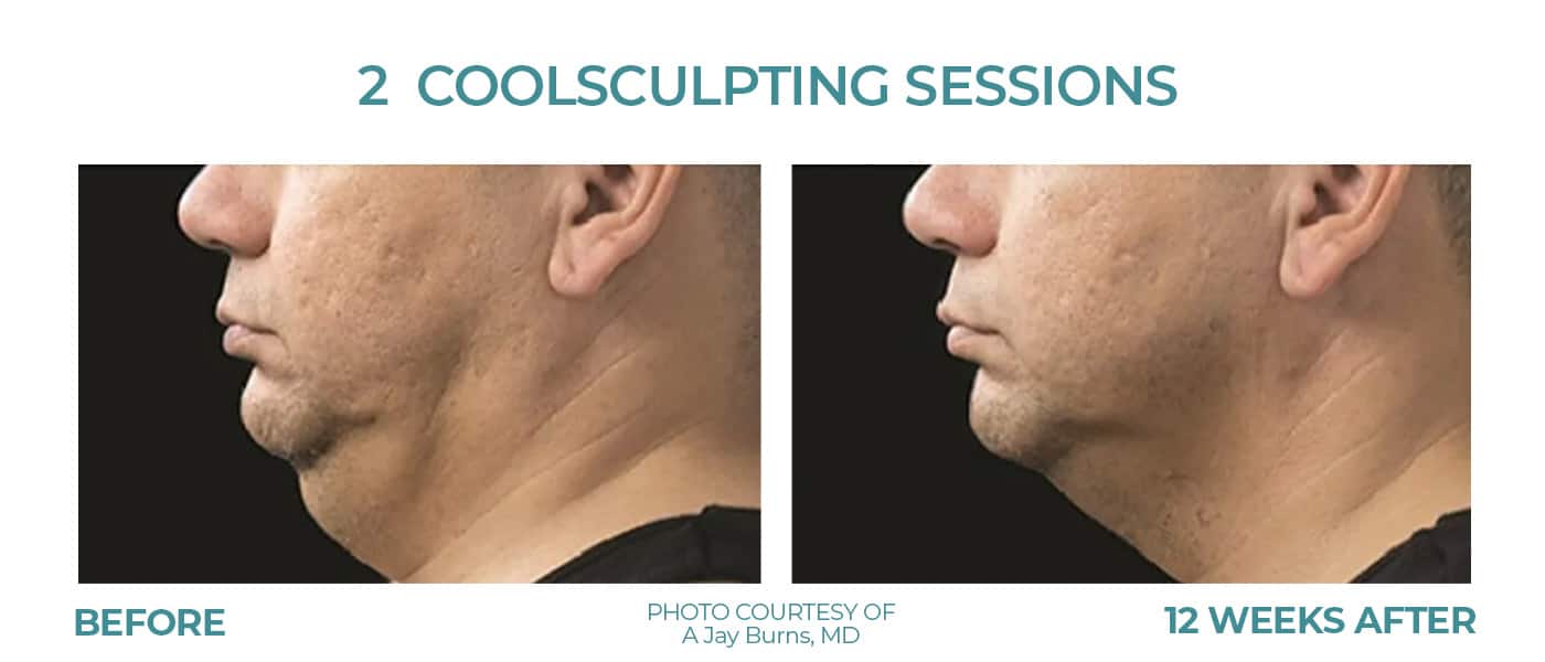 Before and After Image: CoolSculpting – Chin - left-side