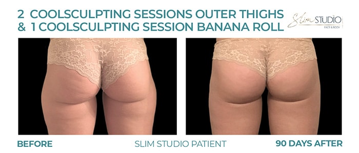 Before and After Image: CoolSculpting – Thighs and Banana Roll - back