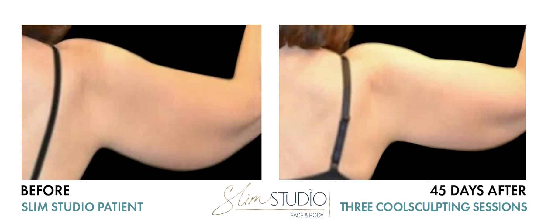 Before and After Image: CoolSculpting – Arms - back
