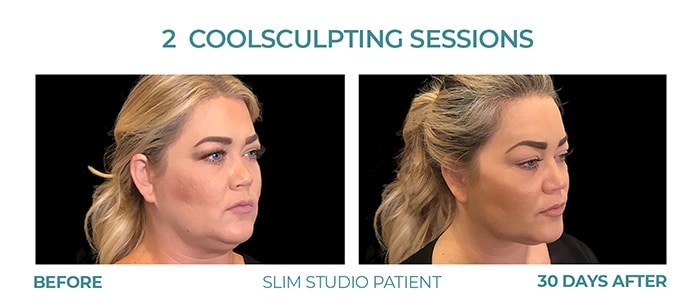 Before and After Image: CoolSculpting – Chin - right-front-oblique