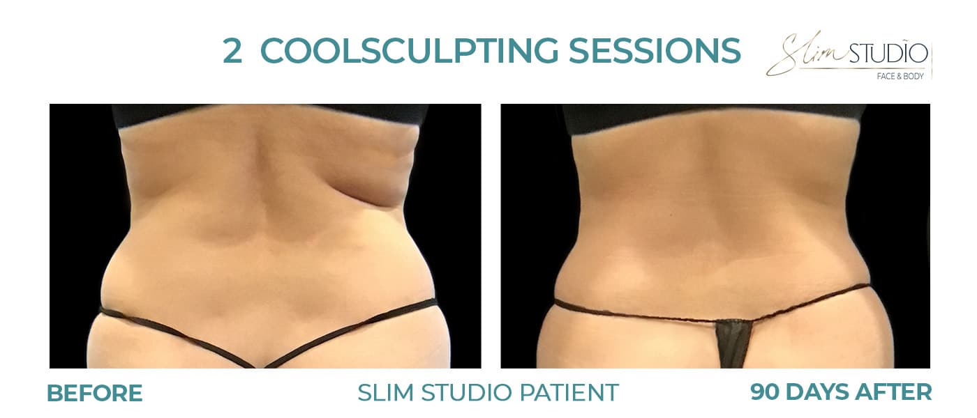 Before and After Image: CoolSculpting – Flanks - back