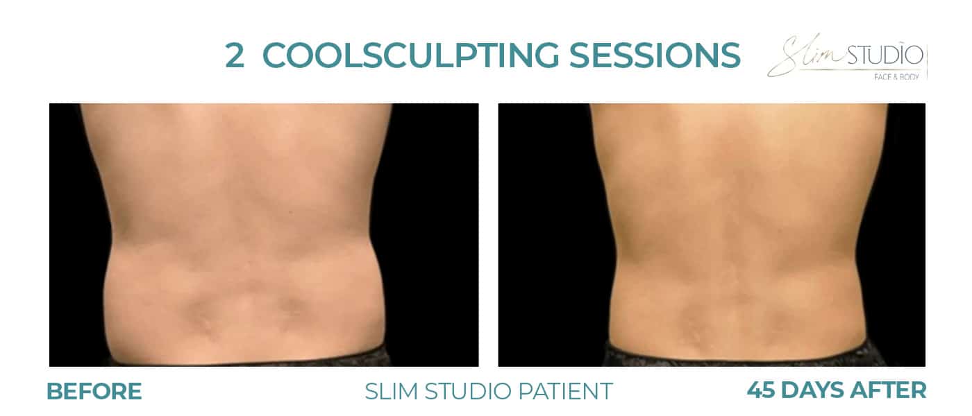 Before and After Image: CoolSculpting – Flanks - back